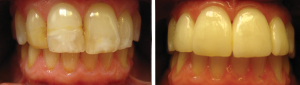 EMAx Crowns