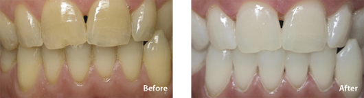 Porcelain Veneers